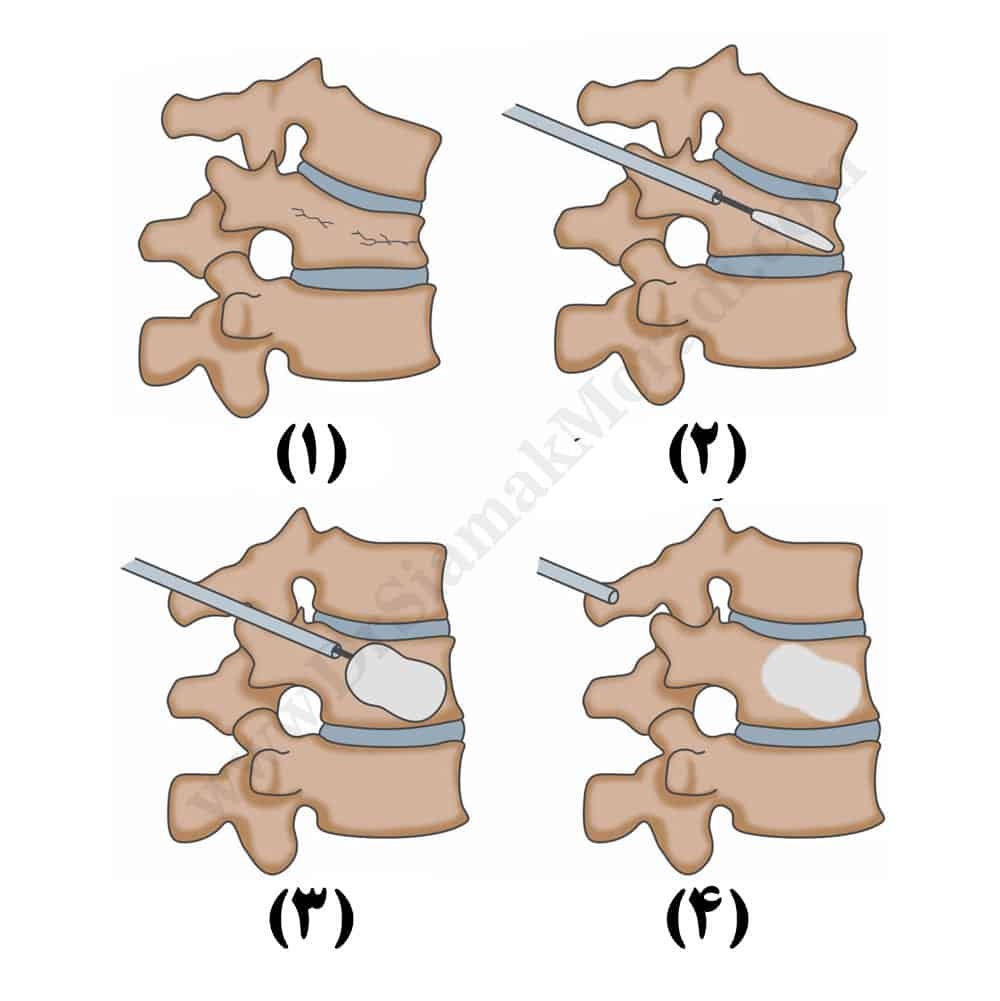 Kyphoplasty-virtualdr-DrSiamakMoradi.com_-2.jpg