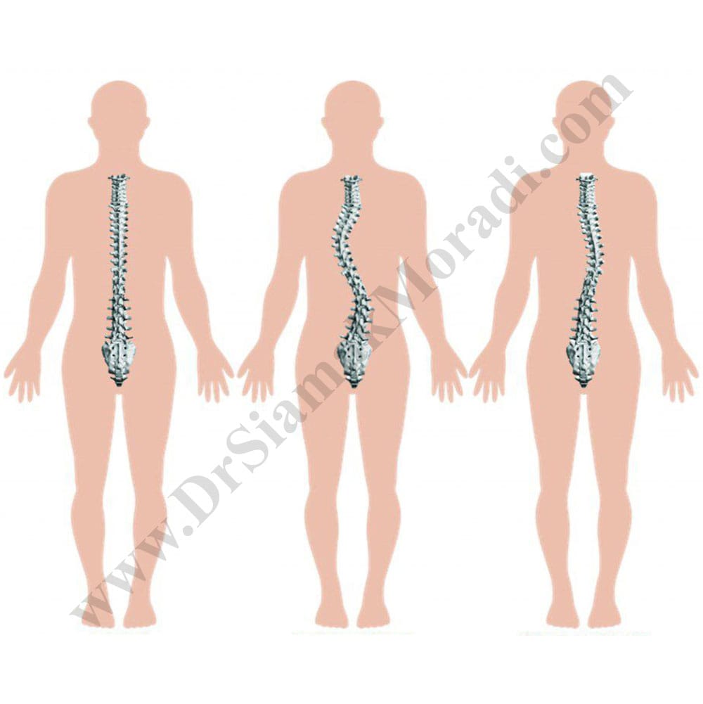 -ستون-فقرات-drsiamakmoradi.com_.jpg