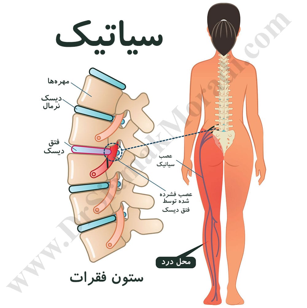 -عصب-سیاتیک.jpg