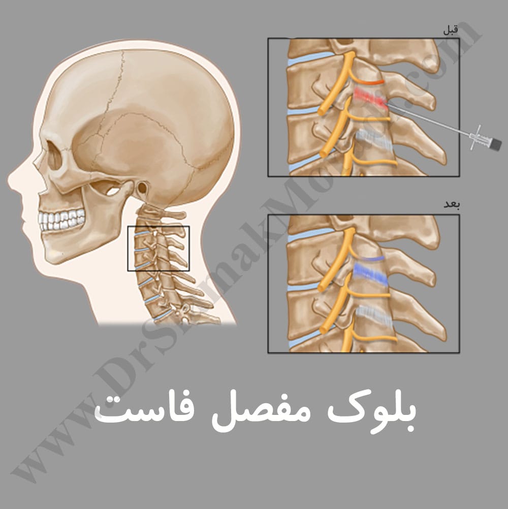 -مفصل-فاست.jpg
