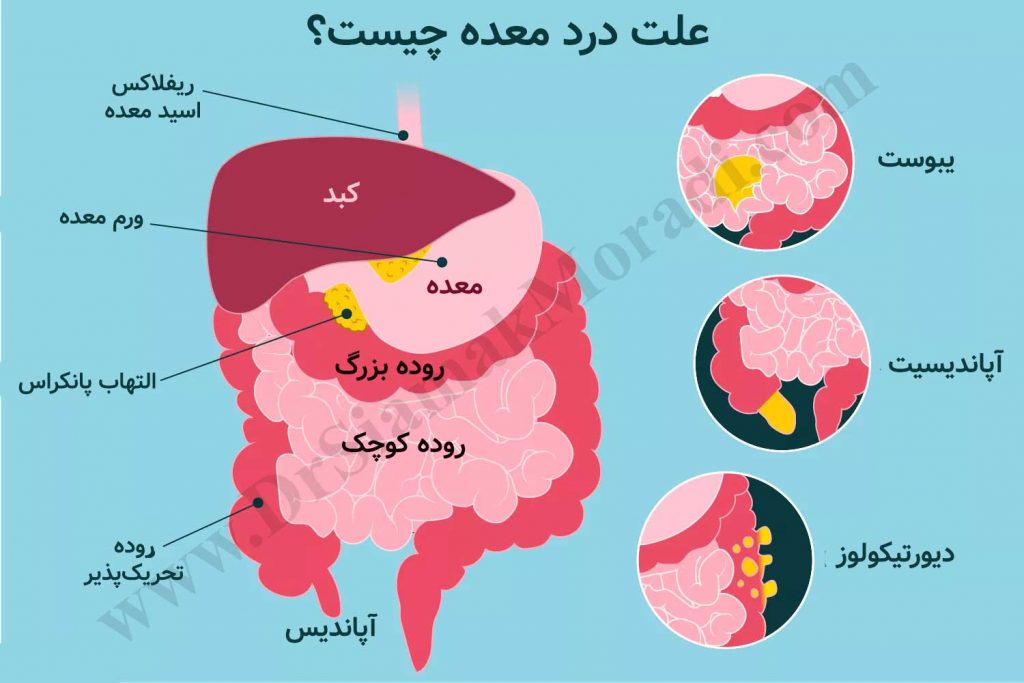 علت درد معده درکتر سیامک مرادی فوق تخصص درد در کلینیک درد تهران