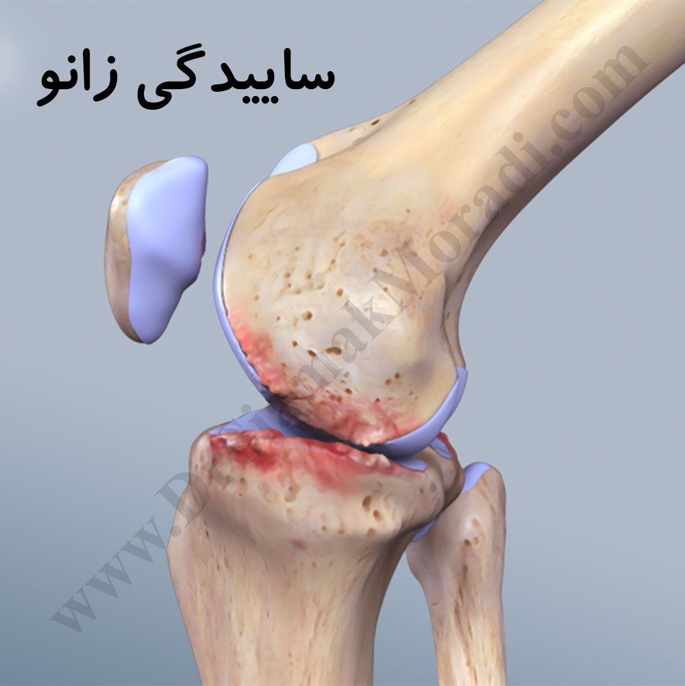 آرتروز یا ساییدگی زانو چیست، علت ها و درمان آن - دکتر سیامک مرادی، فوق تخصص  درد