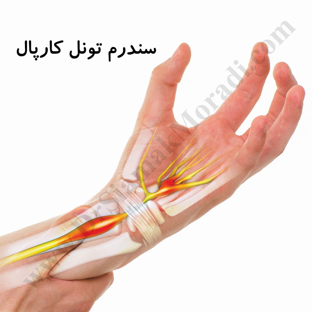 -تونل-کارپال.jpg