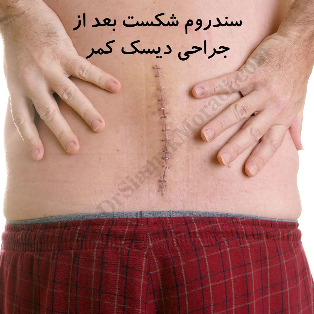 -برگشت-جراحی-دیسک-کمر.jpg