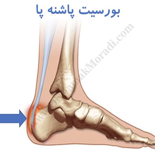 -پاشنه-پا.jpg