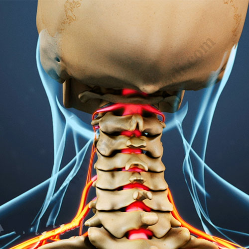 دیسک گردن چیست و درمان آن دکتر سیامک مرادی، فوق تخصص درد