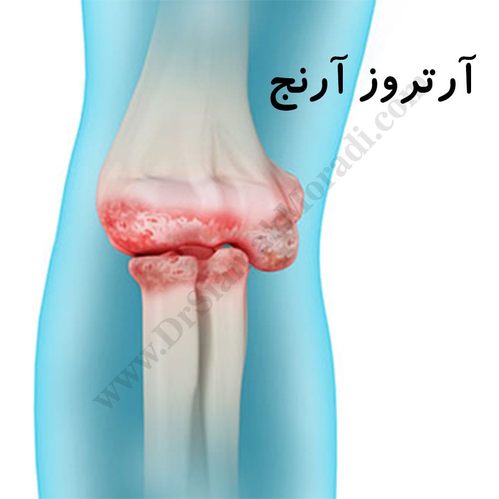 -آرنج-1-1.jpg