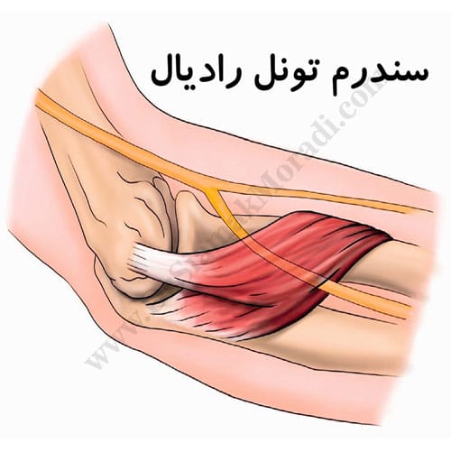 -تونل-رادیال.jpg