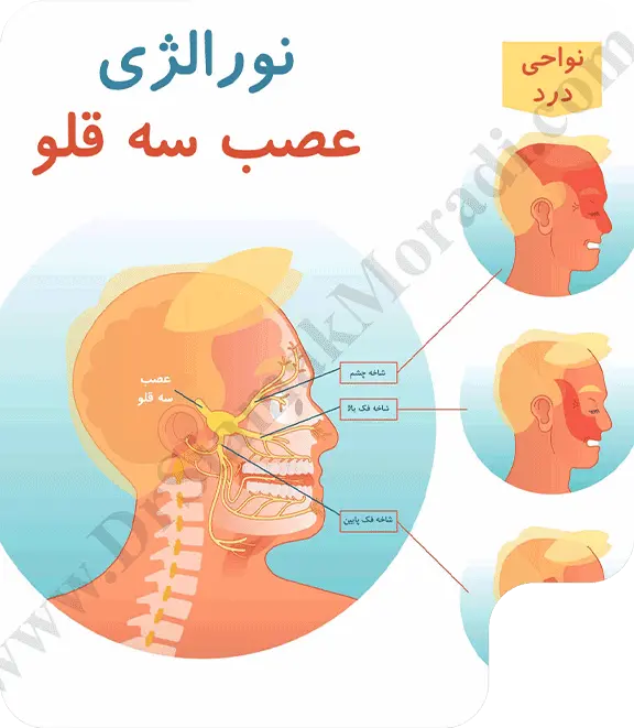 درد عصب سه قلو قلو توسط دکتر سیامک مرادی فوق تخصص درد در تهران در کلینیک درد راد